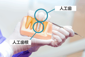 インプラント構造を説明する写真
