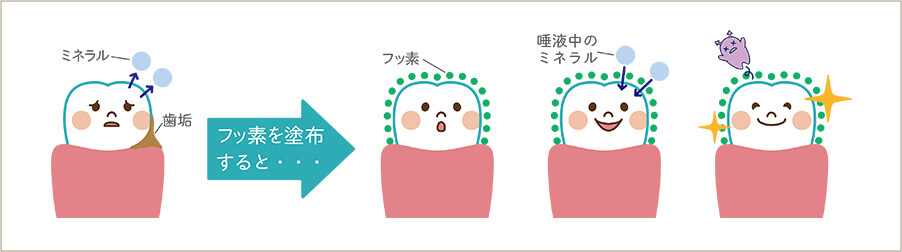 フッ素塗布