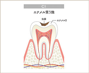 エナメル質まで進行したむし歯