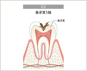 象牙質まで進行したむし歯