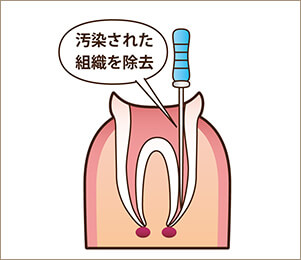 STEP1　歯髄の除去