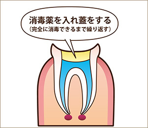 STEP2　根管内の掃除・消毒​