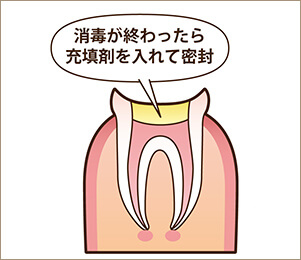 STEP3　充填材を入れて密封