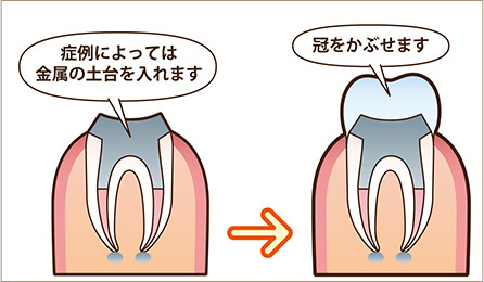 STEP4　土台の構築と被せ物の装着