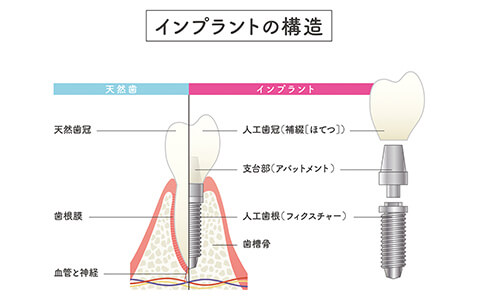 インプラントの構造​