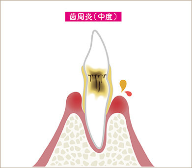 中度歯周病