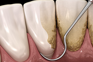 重度歯周病治療（外科的治療）​