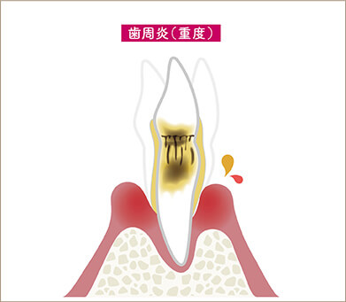 重度歯周病