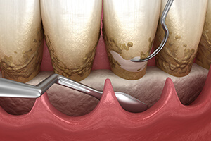 重度歯周病治療（外科的治療）