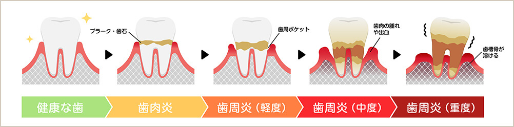 歯周病の進行